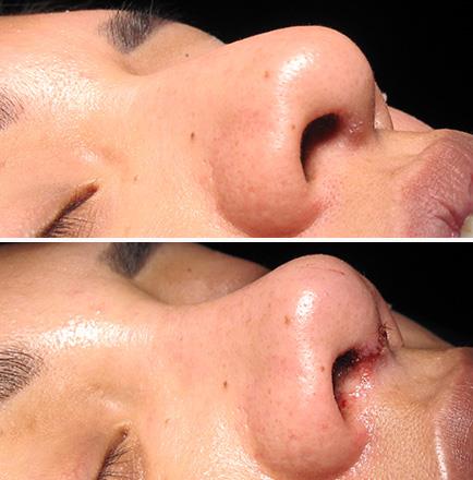 Results Of Rhinoplasty Surgery In Atlanta GA