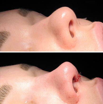 Rhinoplasty Before & After In Atlanta GA