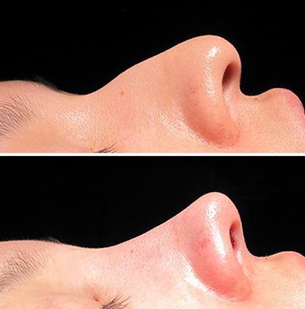 Rhinoplasty Surgery Before & After In Atlanta Georgia