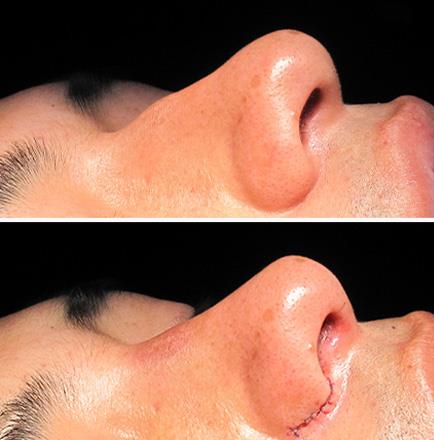 Results Of Rhinoplasty In Georgia