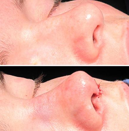 Results Of Nose Surgery In Georgia