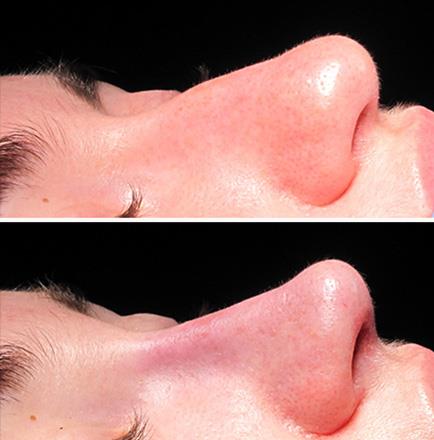 Results Of Rhinoplasty In GA