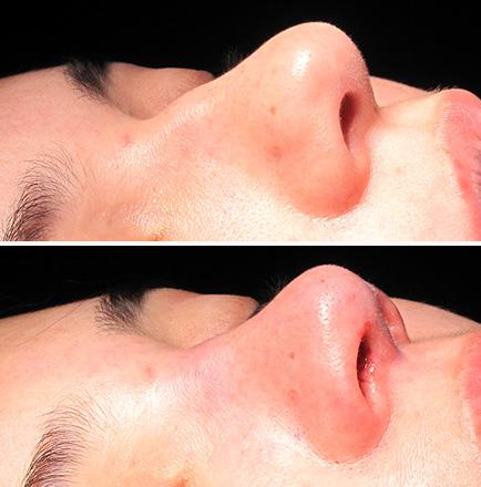 Results Of Nose Surgery In GA