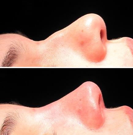 Before & After Scarless Rhinoplasty Surgery Atlanta