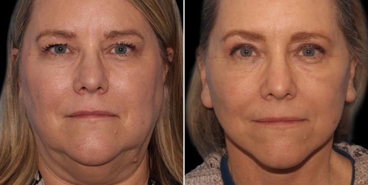 Neck Lift Surgery Results Atlanta GA