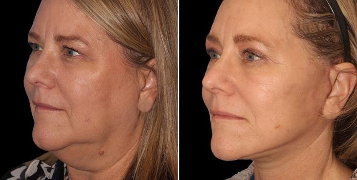 Before & After Neck Lift Surgery Atlanta ¾ Left View