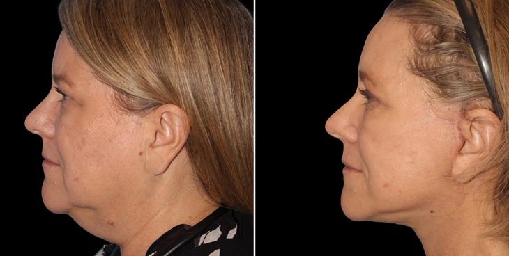 Before & After Neck Lift Surgery Atlanta Left Side View