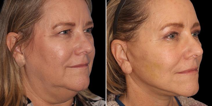 Before & After Neck Lift Surgery Atlanta ¾ Right View