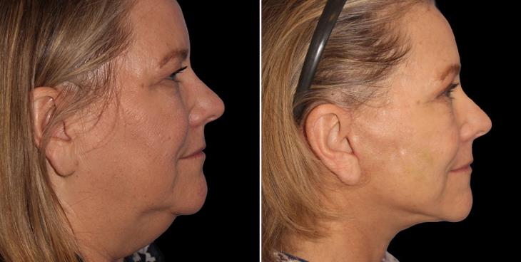 Before & After Neck Lift Surgery Atlanta Right Side View