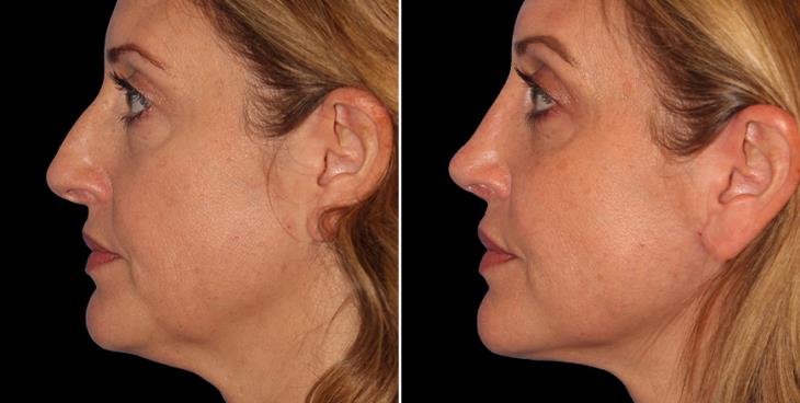 Nose Surgery Results In Alpharetta