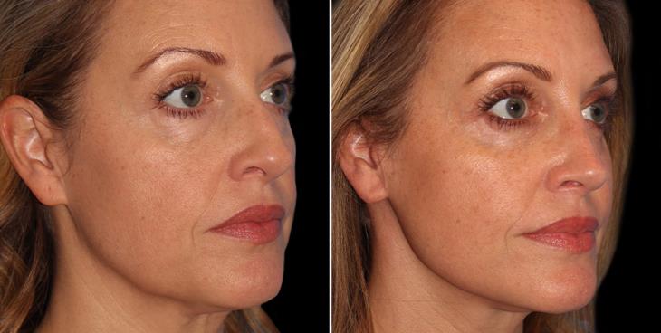 Nose Surgery Results In Alpharetta ¾ Right View