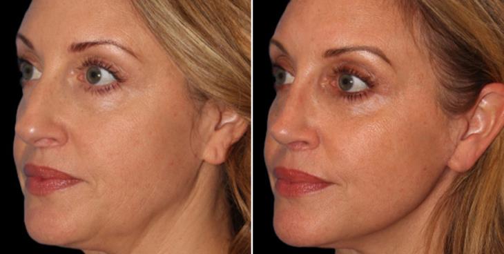 Atlanta Facelift Surgery Results ¾ Left View