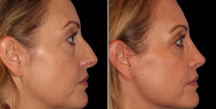 Atlanta Facelift Surgery Results Right Side View