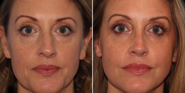 Alpharetta Results Of Blepharoplasty