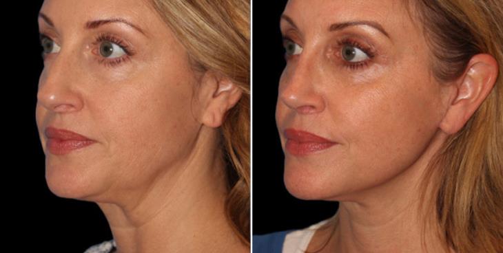 Atlanta Neck Lift Before & After ¾ Left View