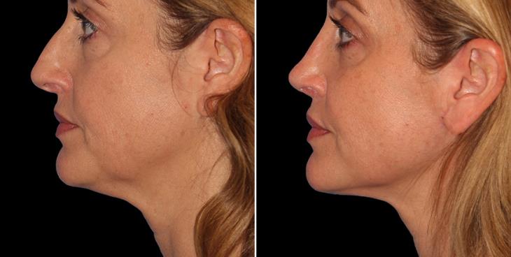 Atlanta Neck Lift Before & After Left Side View