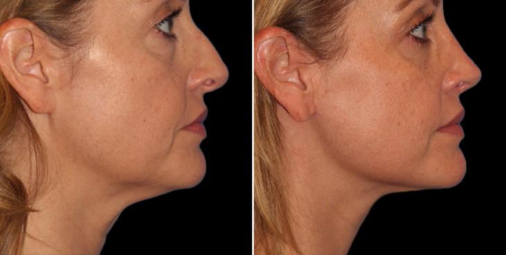 Atlanta Neck Lift Before & After Right Side View