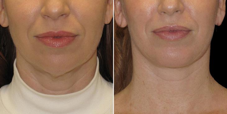 Neck Lift Surgery Results Marietta GA