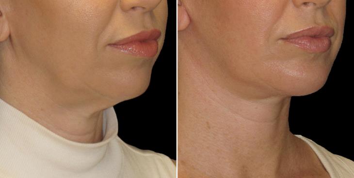 Atlanta Chin Augmentation Results ¾ Right View