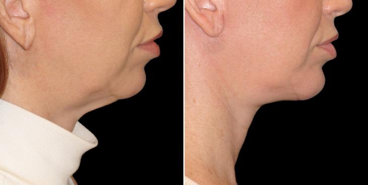 Atlanta Chin Augmentation Results Right Side View