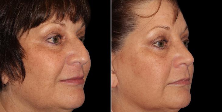 Rhinoplasty 1/4 Right