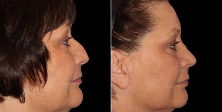 Rhinoplasty Right 