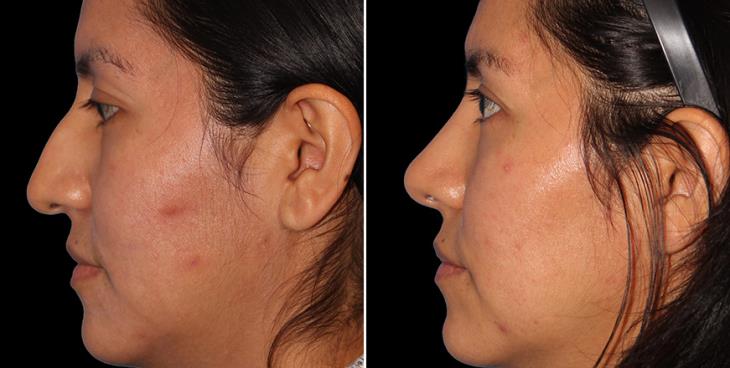 Rhinoplasty L