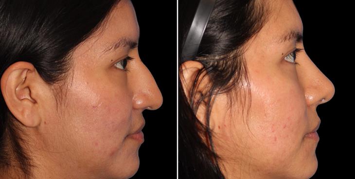 Rhinoplasty R