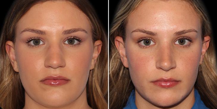 Before & After Closed Nose Surgery Atlanta