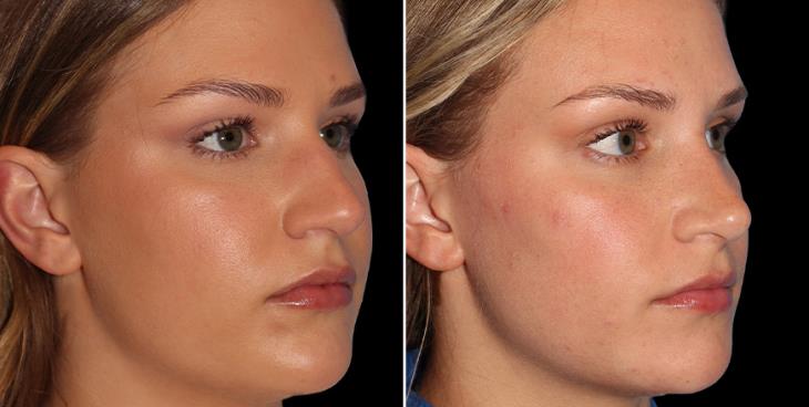 Before & After Closed Nose Surgery Atlanta ¾ Right View