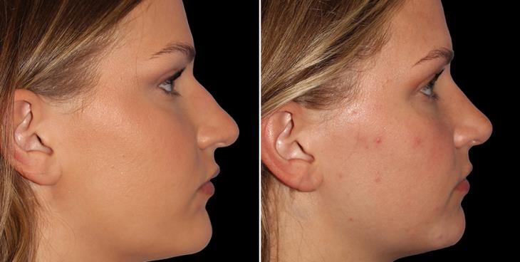 Before & After Closed Nose Surgery Atlanta Right View