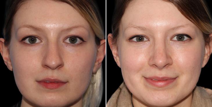 Closed Rhinoplasty Results In Atlanta GA