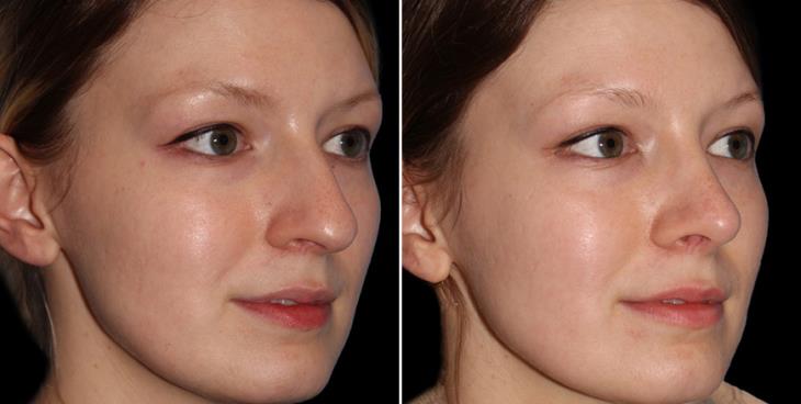 Closed Rhinoplasty Results In Atlanta GA ¾ Right View