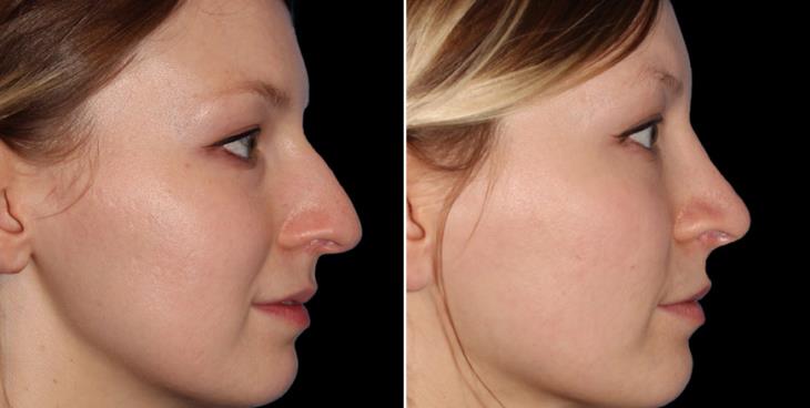 Closed Rhinoplasty Results In Atlanta GA Right View