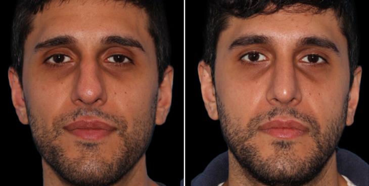 Male Closed Rhinoplasty Before & After