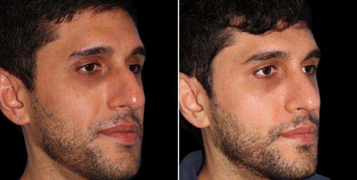 Male Closed Rhinoplasty Before & After ¾ Right View