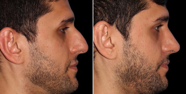 Male Closed Rhinoplasty Before & After Right View