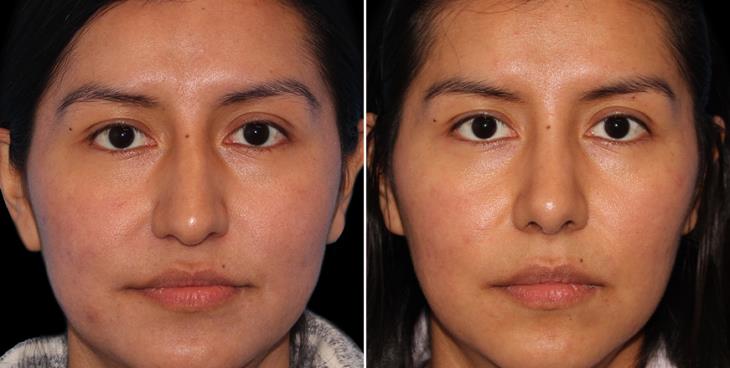 Closed Nose Surgery Before & After Atlanta