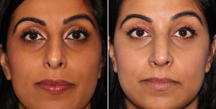 Atlanta Georgia Nose Reshaping Surgery Results