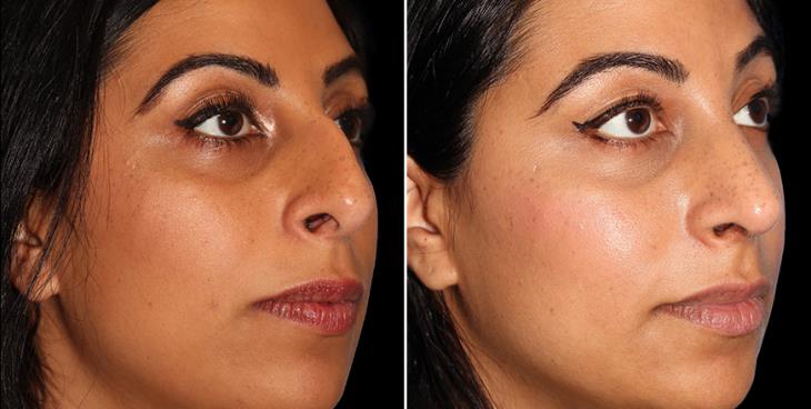 Atlanta Georgia Nose Reshaping Surgery Results ¾ Right View