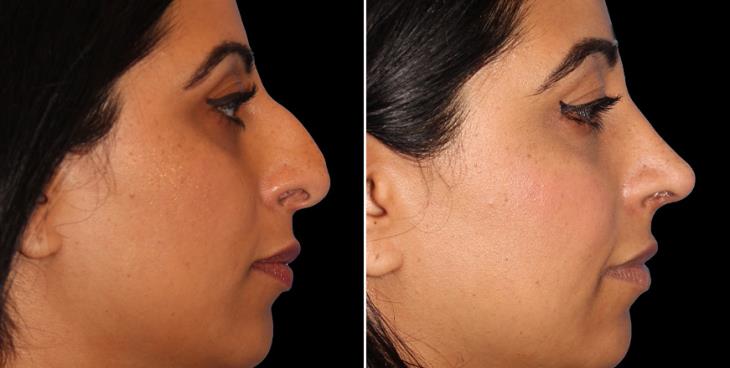 Atlanta Georgia Nose Reshaping Surgery Results Right View