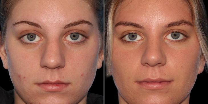 Atlanta Nose Surgery Results Before & After