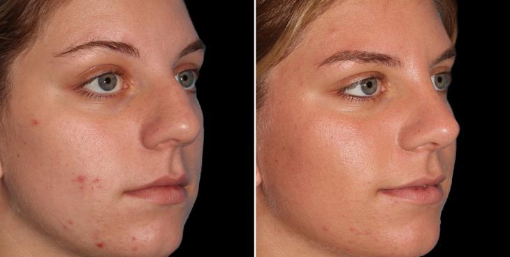 Atlanta Nose Surgery Results Before & After ¾ Right View