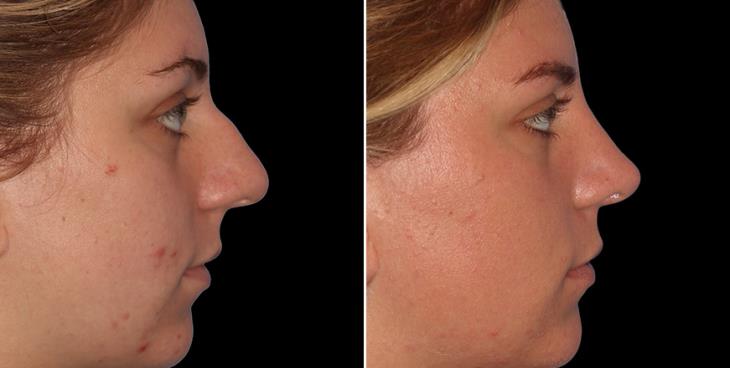 Atlanta Nose Surgery Results Before & After Right View