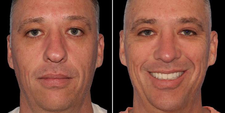 Men’s Nose Reshaping Results Atlanta