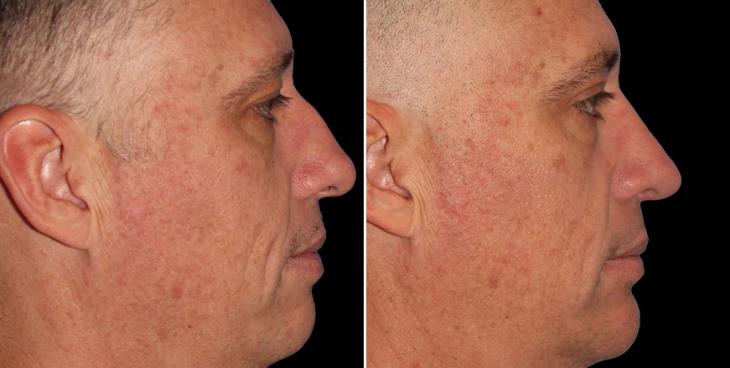 Men’s Nose Reshaping Results Atlanta ¾ Right View