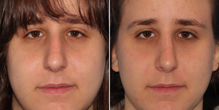 Before And After Nose Surgery Results Atlanta