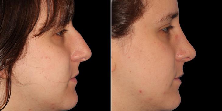 Before And After Nose Surgery Results Atlanta ¾ Right View