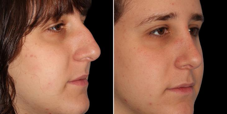 Before And After Nose Surgery Results Atlanta Side View