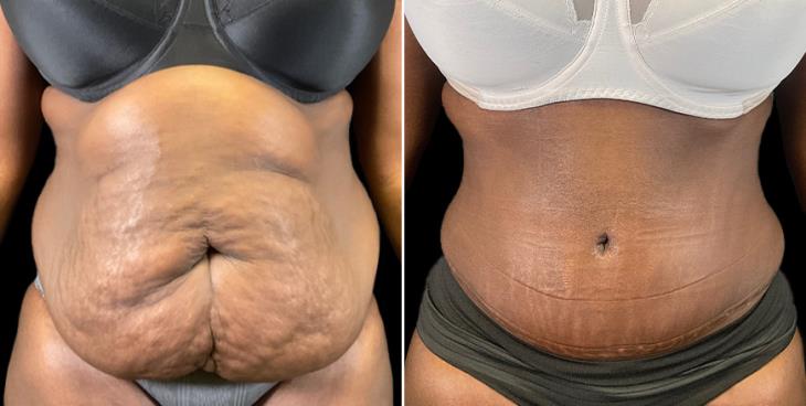 Results Of Tummy Tuck Surgery In Atlanta GA